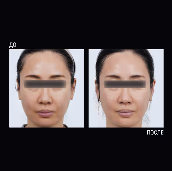 до и после процедуры Ultraformer MPT