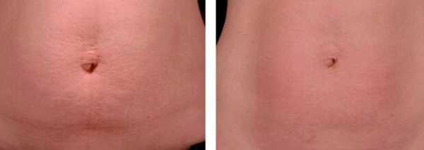 Лазерный фототермолиз кожи передней стенки живота:
( снижение тонуса кожи и растяжки после беременности) 1 процедура Результат через 2 месяца